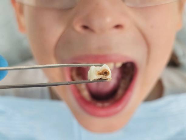 Best Emergency Wisdom Tooth Extraction in Lawson, MO